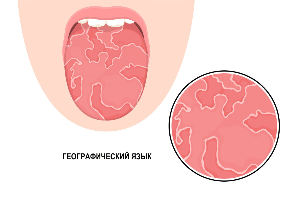 Схема языка с зонами возможного воспаления и боли