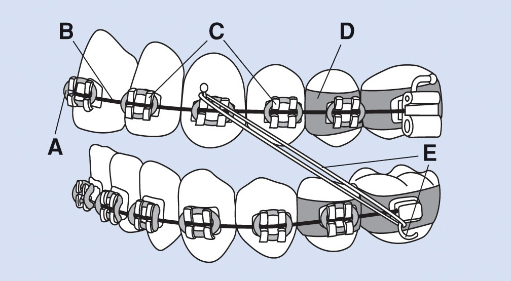 Устройство брекета с крючками для эластиков